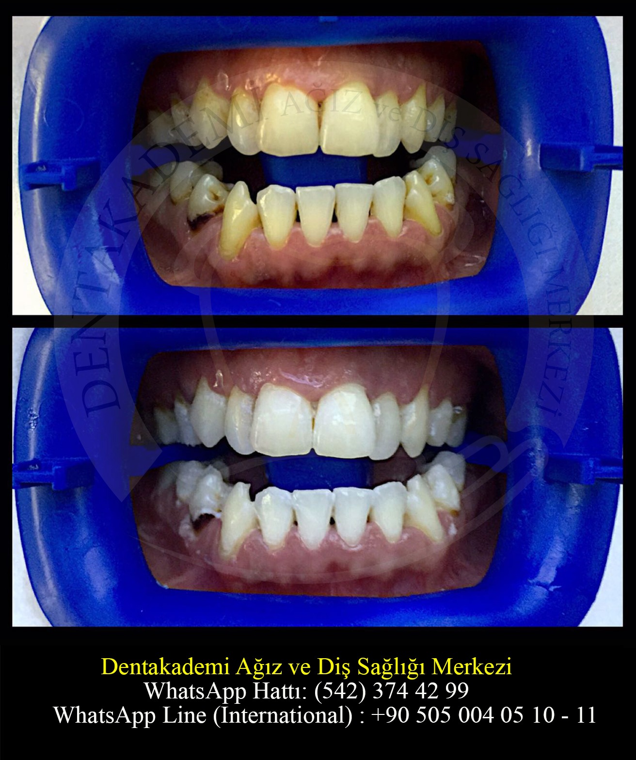 Blanchiment Dentaire